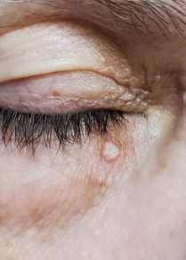 cholesterol deposit removal near eyes